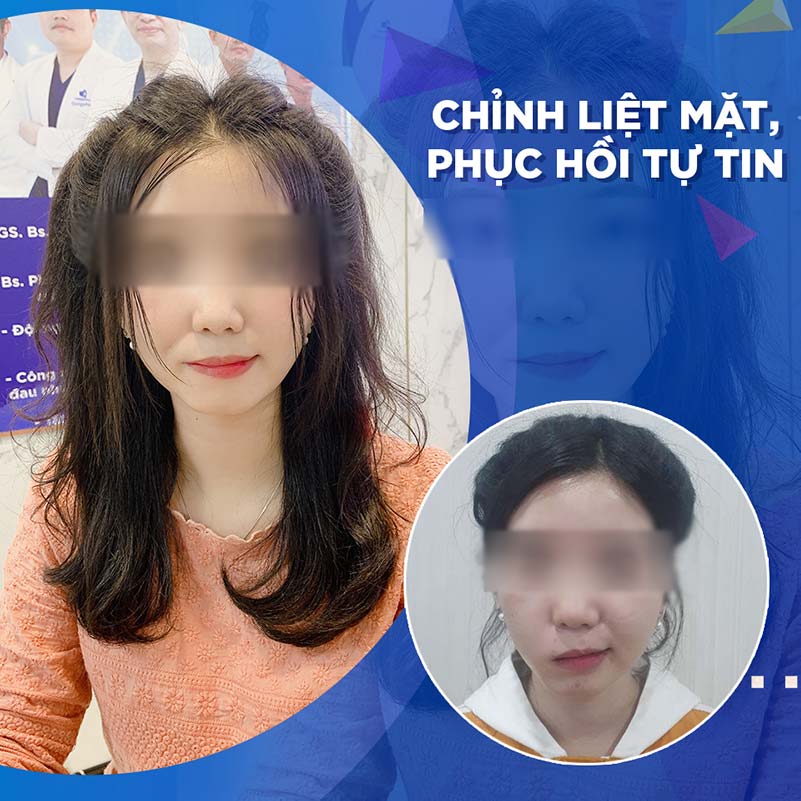 Image of our customer before & after facial paralysis treatment at Gangwhoo Cosmetic Hospital