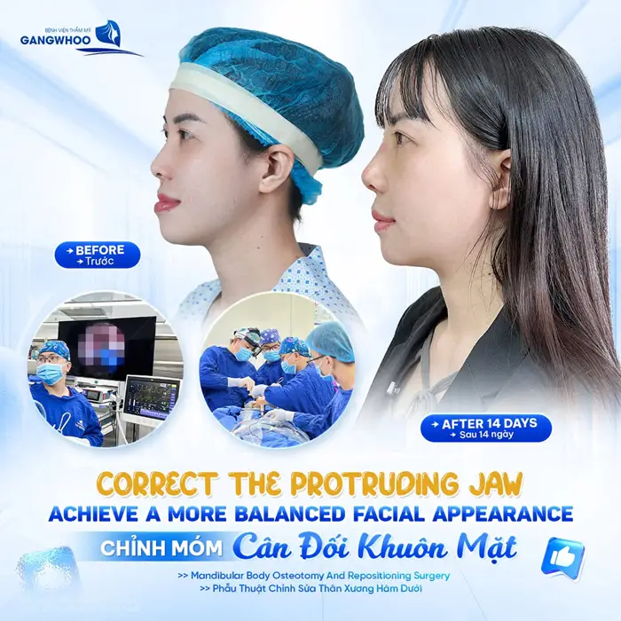 Chỉnh Hàm Hô Móm Có Nguy Hiểm Không? Quy Trình An Toàn