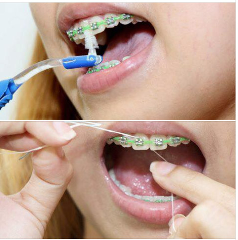 Cách chăm sóc sau niềng răng