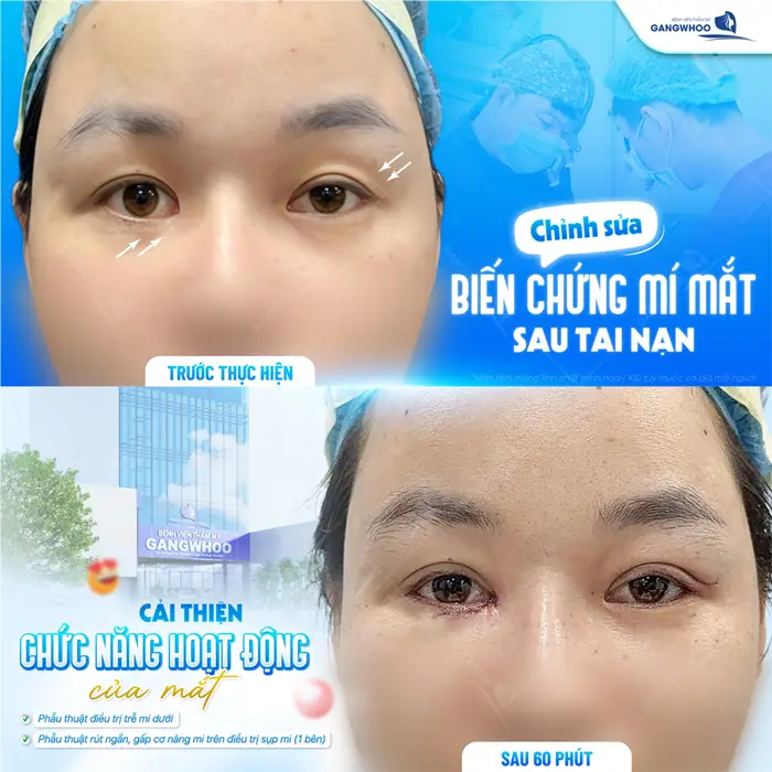 Chỉnh sửa biến chứng mắt sau tai nạn cải thiện chức năng hoạt động của mắt sau 60 phút đã đẹp hài hòa hơn 