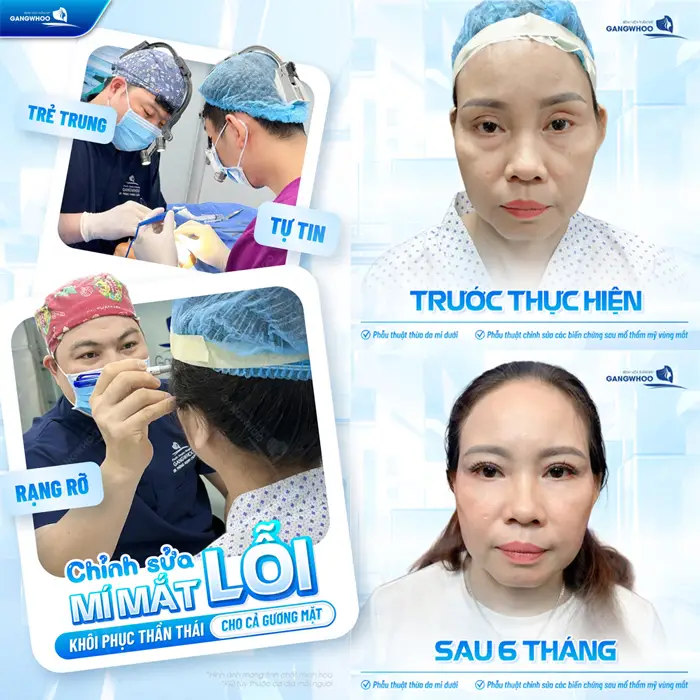 Chỉnh sửa mĩ mắt lỗi khôi phục thần thái cho cả gương mặt sau 6 tháng đôi mắt hài hòa và cân đối hơn thấy rõ