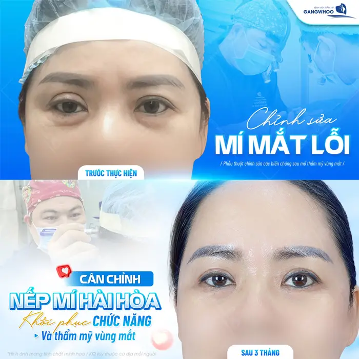 Sửa Mí Hỏng Hậu Phẫu Thuật - Những Điều Cần Lưu Ý 3 Chỉnh sửa mắt lỗi cân chỉnh nếp mí hài hòa khôi phục chức năng và thẩm mỹ cho vùng mắt
