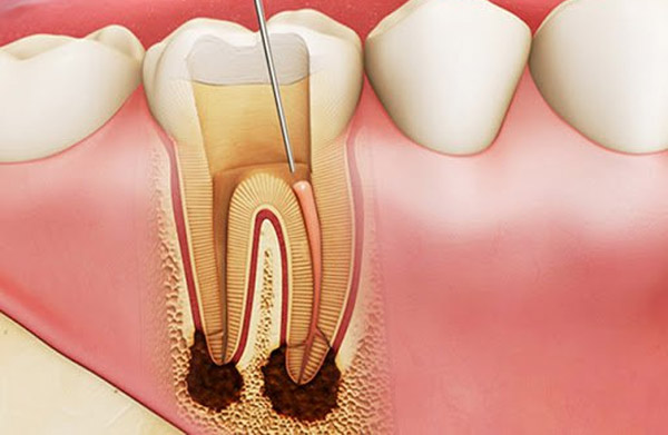 Điều trị tủy răng để phục hồi chức năng của răng