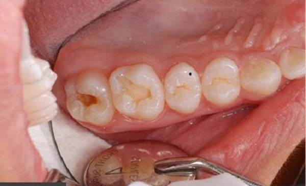Chữa Tủy Răng để tránh các bệnh về răng miệng