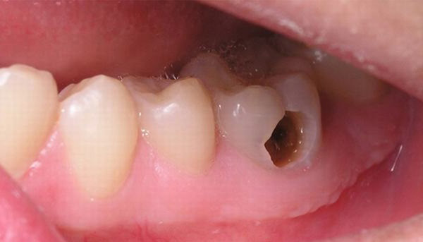 Điều trị tủy răng - Nha Khoa Gangwhoo