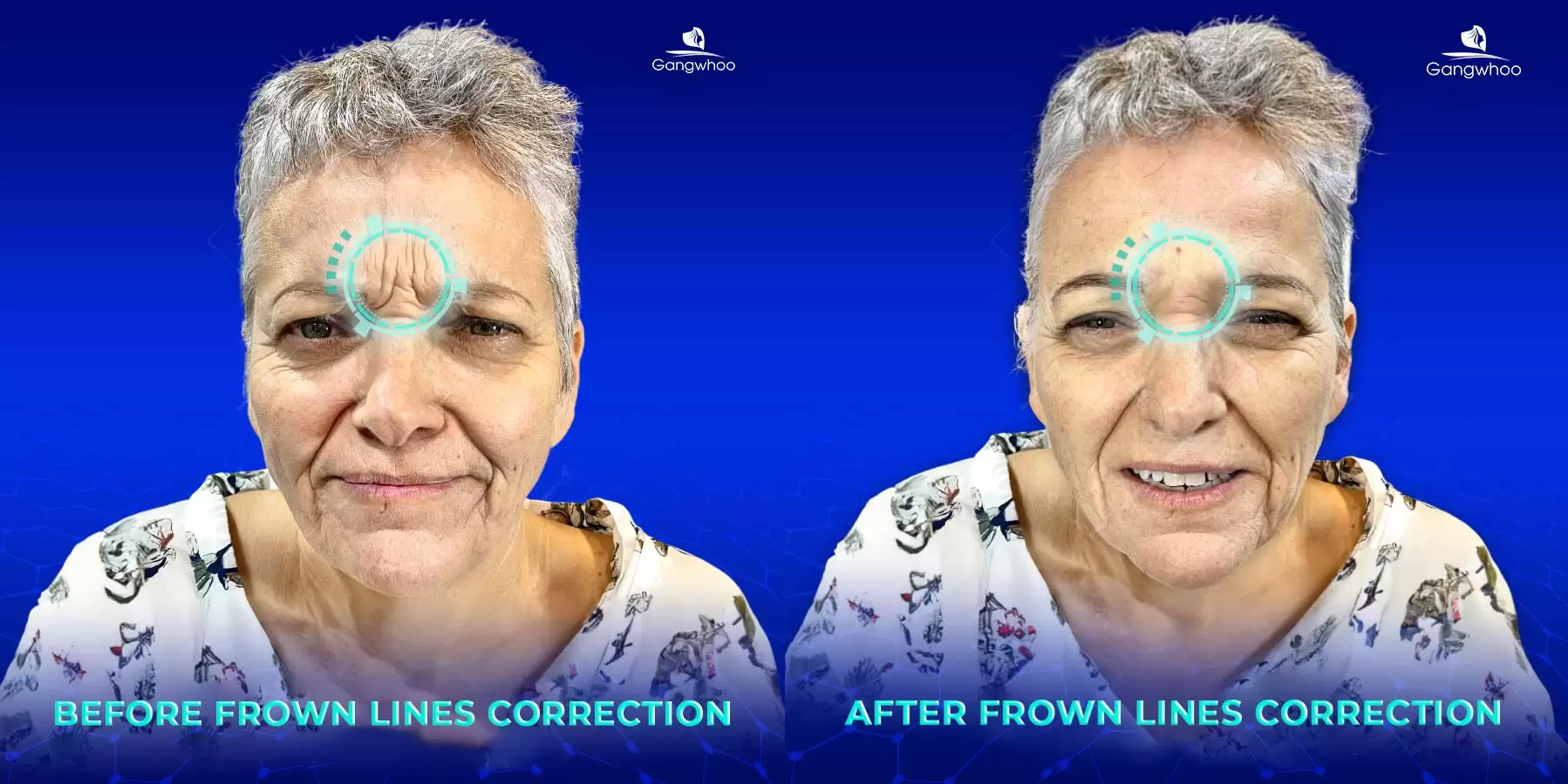 Corrugator Supercilii Muscle Immobilization - For A Brighter Face 4 co cau may 1