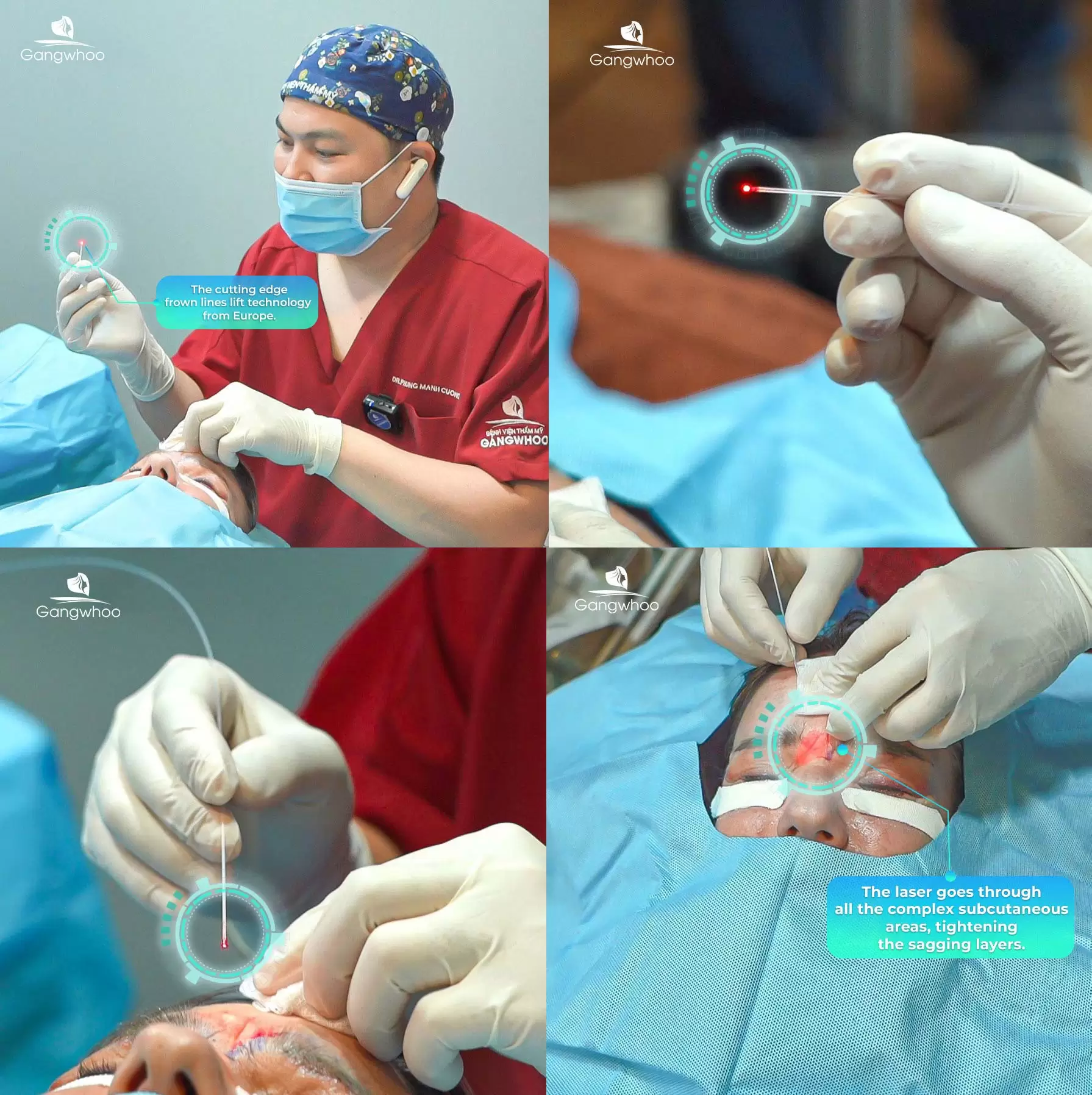 Corrugator Supercilii Muscle Immobilization - For A Brighter Face 2 co cau may 4