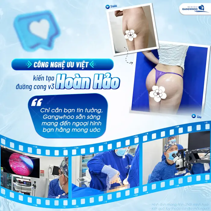 Nâng Mông Nội Soi "Tôn Vinh Vòng 3 Căng Tròn Quyến Rũ" 1 Nâng mông công nghệ ưu việt kiến tạo vòng 3 hoàn hảo như mong đợi