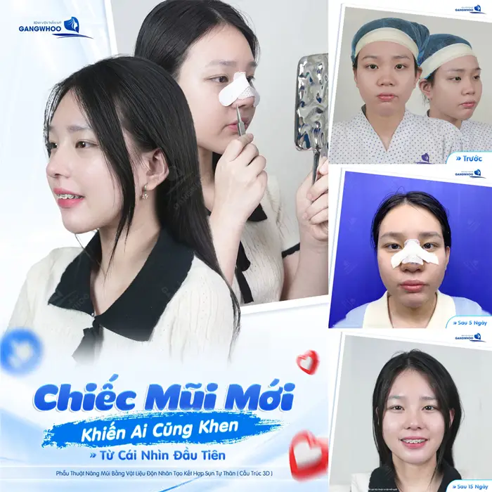 Chiếc mũi mới khiến ai cũng khen từ cái nhìn đầu tiên đã trở nên xinh đẹp và đầy rạng rỡ