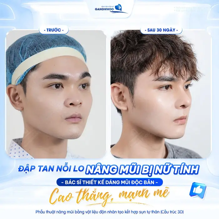 Nâng mũi cho nam đẹp cao thẳng vẫn giữ được nét đẹp nam tính kết quả sau 30 ngày gương mặt thêm bừng sáng 