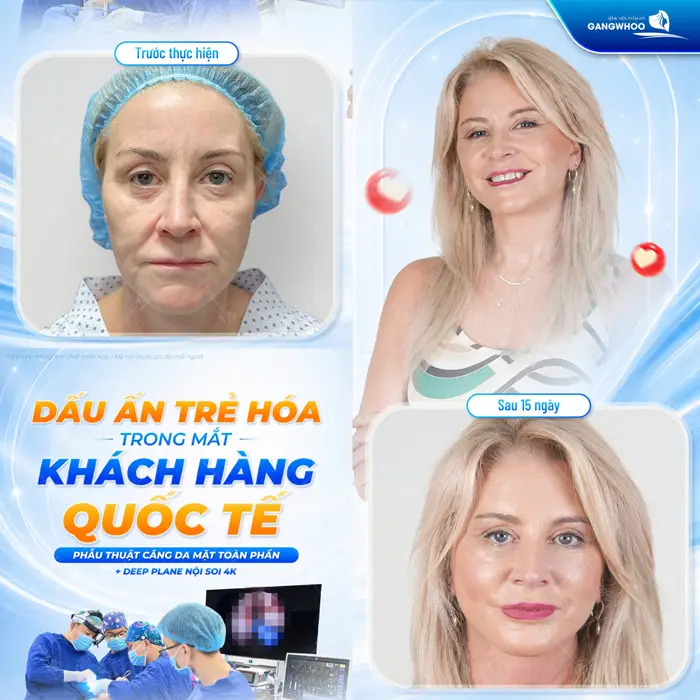 TOP 10 Địa Chỉ Căng Da Mặt Uy Tín Tại TP Hồ Chí Minh 5 Dấu ấn trẻ hóa trong mắt khách hàng quốc tế sau phẫu thâutj căng da mặt toàn phần