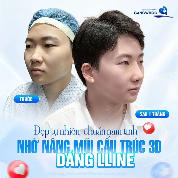 Đẹp tự nhiên, chuẩn nam tính nhờ nâng mũi cấu trúc 3D dáng mũi L Line 