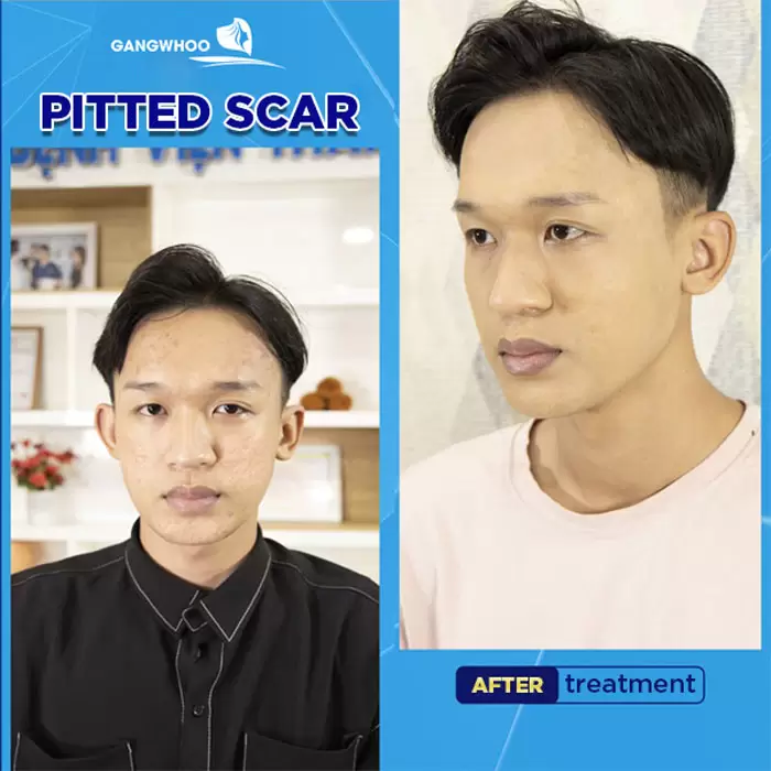 derma roller 1