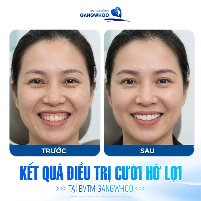 Kết quả điều trị cười hở lợi an toàn và hiệu quả rõ rệt tại BVTM Gangwhoo