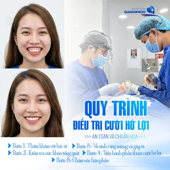Điều Trị Cười Hở Lợi Cho Nụ Cười Quyến Rũ, Đẹp Tự Nhiên