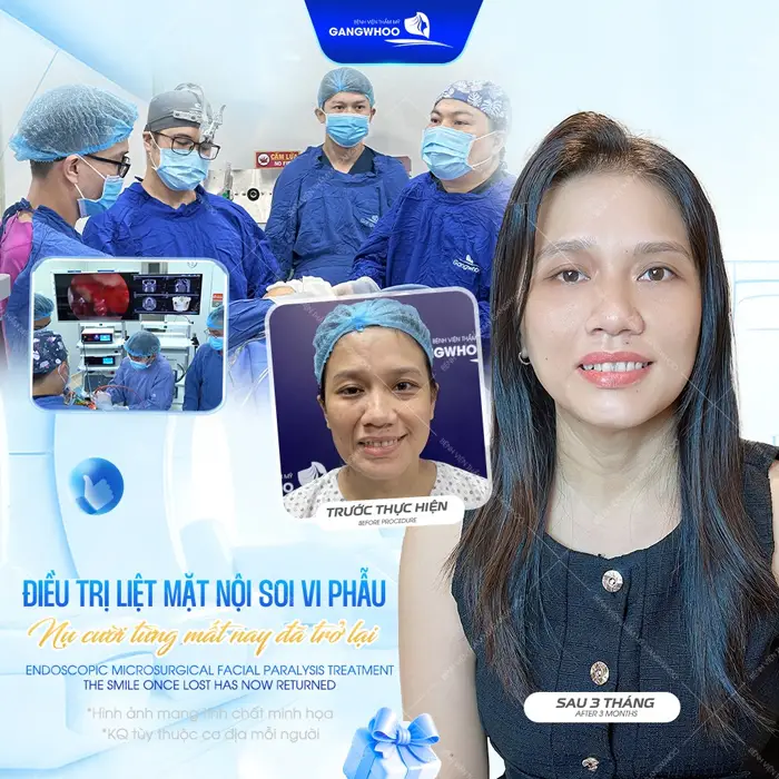 Điều trị liệt mặt nội soi vi phẫu nụ cười hạnh phúc đã mỉm cười trở lại sau 3 tháng can thiệp phẫu thuật 