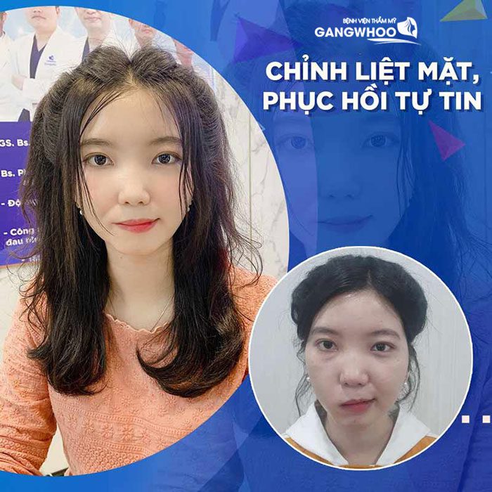 Khách Hàng Điều Trị Liệt Mặt Sau 3 Năm Tại BVTM Gangwhoo