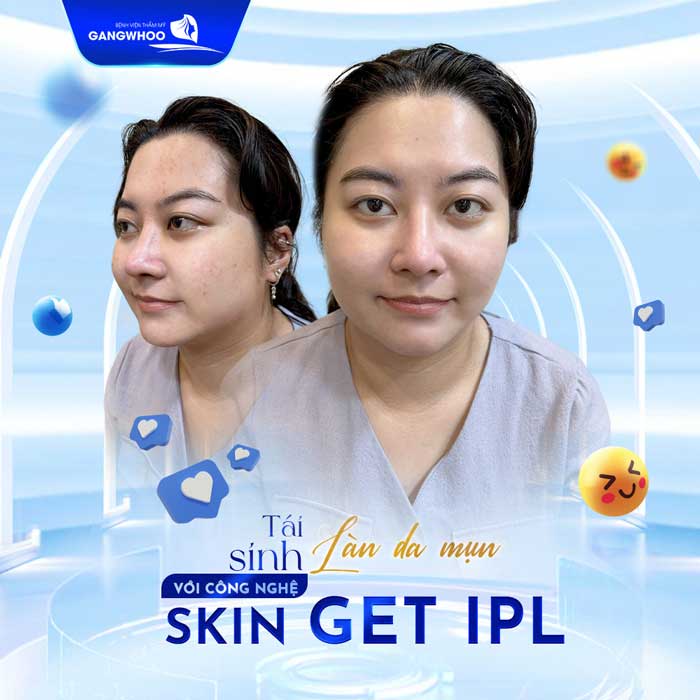 Điều Trị Mụn Skin Get - IPL, Giải Quyết Mụn Sau 1 Liệu Trình
