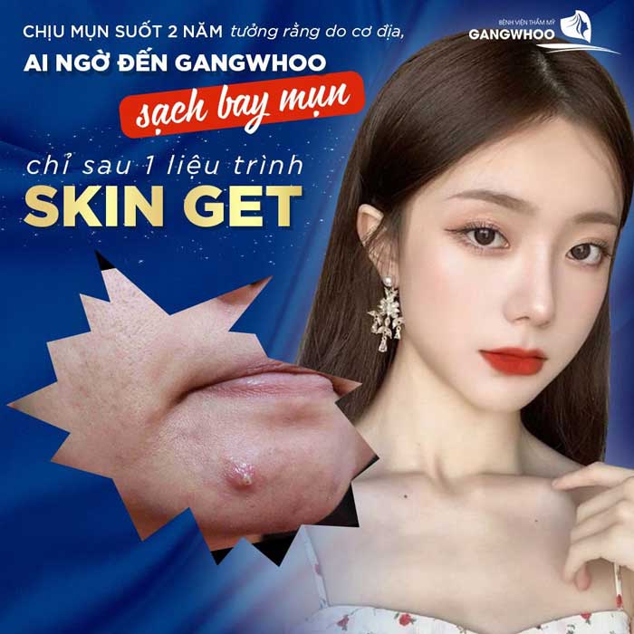 Công nghệ điều trị mụn (Skin Get – IPL) tại BVTM Gangwhoo 