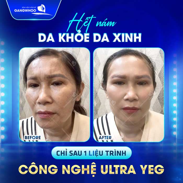 Điều Trị Nám (Ultra YEG) "Tạm Biệt Thâm Nám Tươi Trẻ Làn Da" 3 Đánh bay nám sau 1 liệu trình