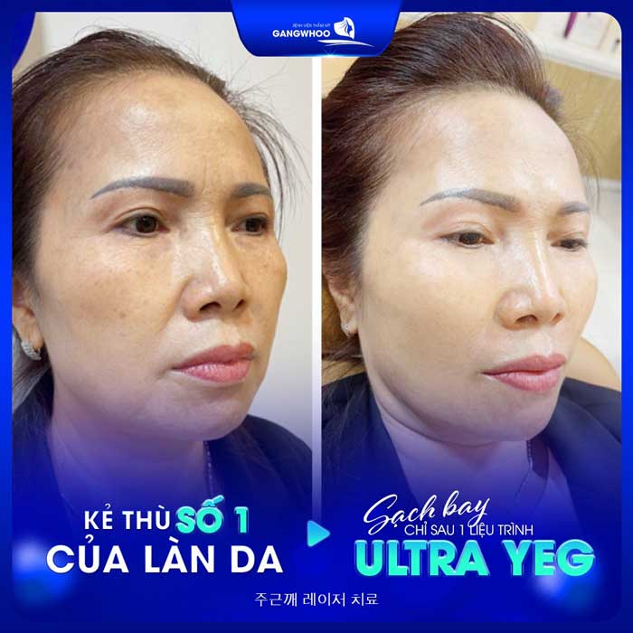 Điều Trị Nám (Ultra YEG) "Tạm Biệt Thâm Nám Tươi Trẻ Làn Da" 2 Điều Trị Nám (Ultra YEG) - Tạm Biệt Làn Da Tối Màu