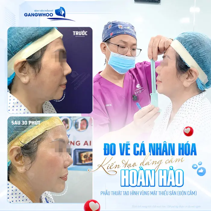 Đo vẽ cá nhân kiến to dáng cằm hoàn hảo phù hợp với đường nét cho tổng thể khuôn mặt