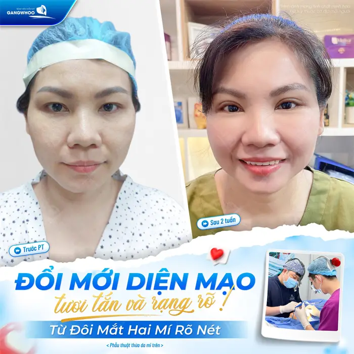 Đổi mới diện mạo tươi tắn và rạng rỡ từ đôi mắt 2 mí rõ nét đến ánh nhìn thêm thu hút và ấn tượng