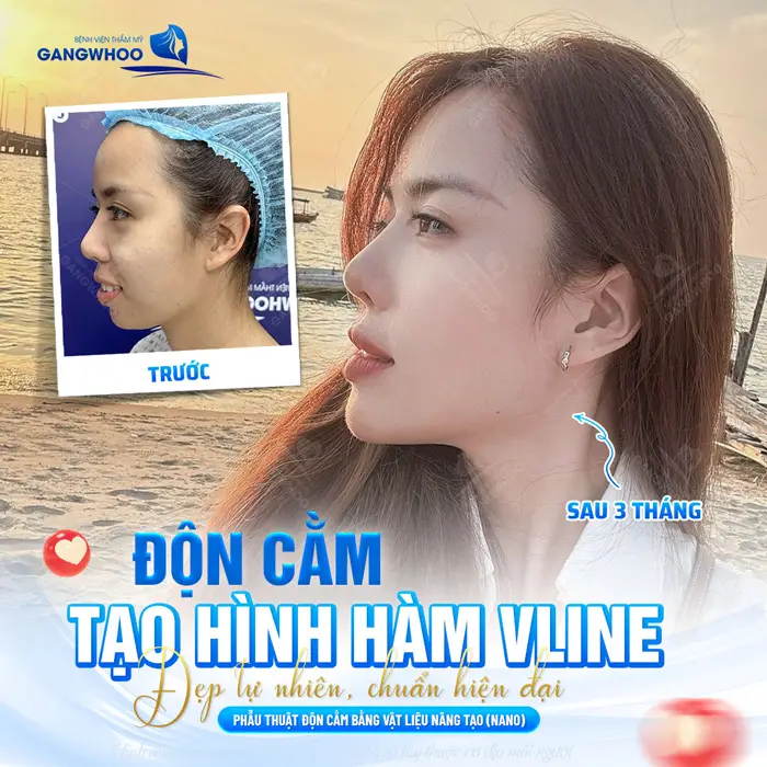 Phẫu thuật độn cằm bằng vật liệu nhân tạo mặt đẹp thon gọn, chuẩn tự nhiên như hiện đại