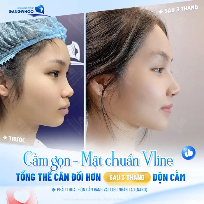 Cằm gọn, mặt chuẩn V Line bí quyết cho gương mặt thêm hài hòa, cân đối sau 3 tháng độn cằm 