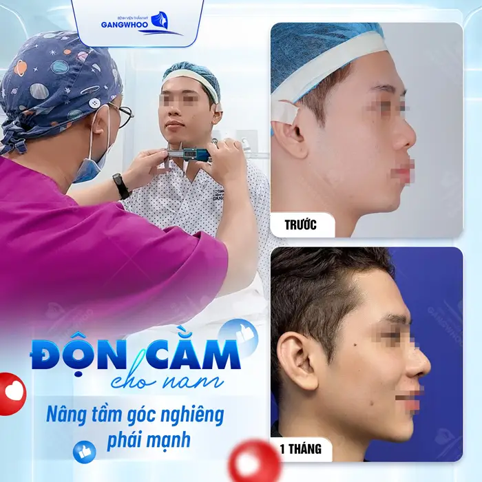 Độn cằm cho nbam nâng tầm góc nghiêng tôn nét đẹp cho phái mạnh