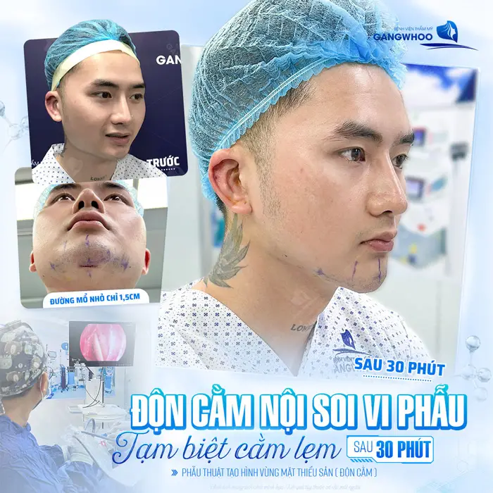 Độn cằm nội soi vi phẫu tạm biệt cằm lẹm sau 30 phút gương mặt đã thay đổi và hài hòa thấy rõ