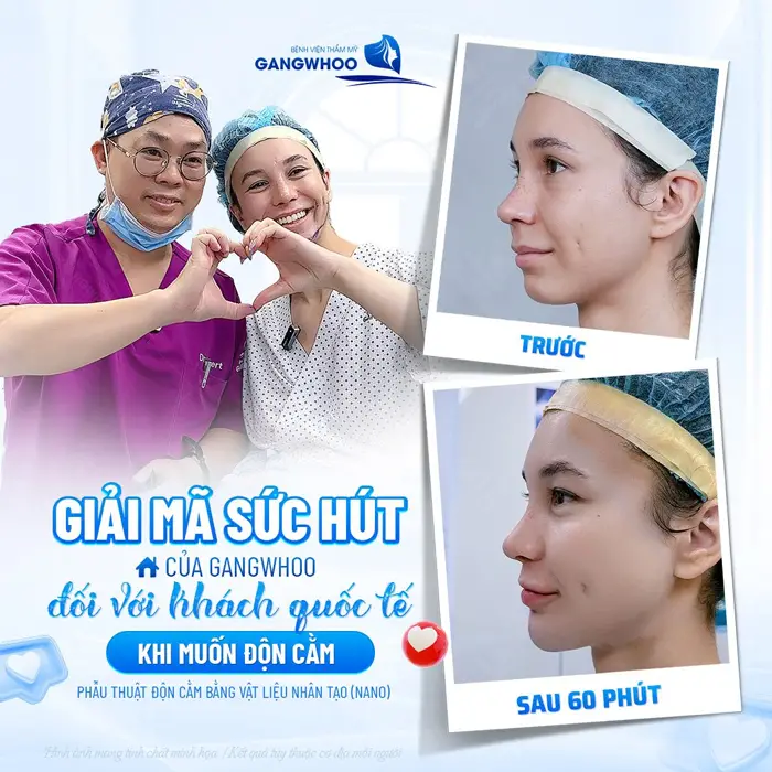 Phẫu thuật độn cằm bằng vật liệu độn nhân tạo lựa chọn của khách quốc tế cho vùng hàm thon gọn 