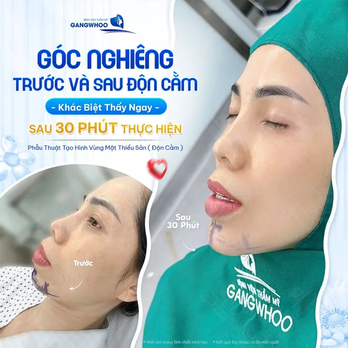 Độn Cằm V-line Nội Soi Vi Phẫu Là Gì? Những Ưu Điểm Vượt Trội 12 Góc nghiêng trước và sau độn cằm khác biệt thấy ngay sau 30 phút thực hiện