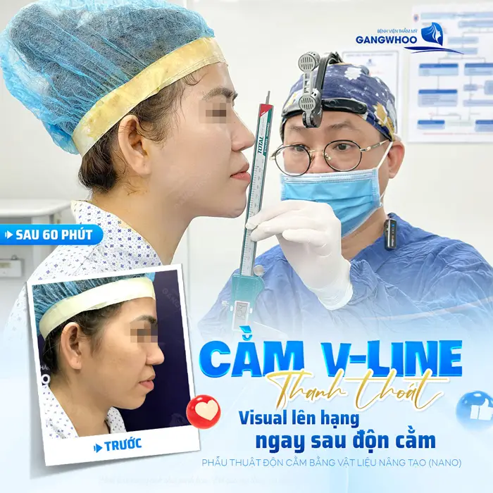 Phẫu thuật độn cằm bằng vật liệu độn toát thần thái với góc nghiêng thanh thoát sau phẫu thuật 