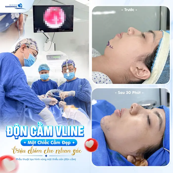 Độn Cằm Korea Implant Sở Hữu Gương Mặt V-Line Nhanh Chóng 4 Độn cằm V Line một chiếc cằm tôn đường nét cuốn hút cho diện mạo và nhan sắc