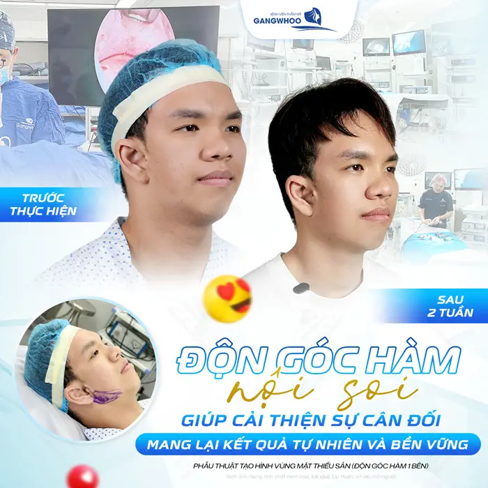 Độn góc hàm nội soi giúp cải thiện sự cân đối giúp mang lại kết quả tự nhiên và bền vững sau phẫu thuật 