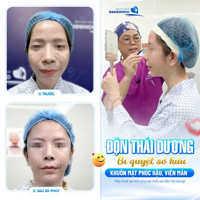 Độn Thái Dương Là Gì? Ưu Điểm Và Chất Liệu Độn 8 Độn thái dương bí quyết giúp sở hữu khuôn mặt phúc hậu, viên mãn sự cải thiện chỉ sau 30 phút gương mặt đã đẹp hài hòa hơn thấy rõ