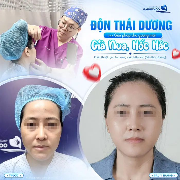 Độn thái dương giải pháp cho gương mặt già nua, hốc hác thêm tươi tắn và trẻ đẹp đầy rạng rỡ