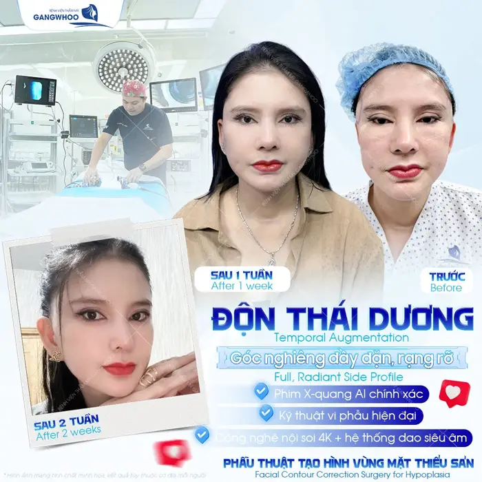 Sau 1 tuần độn thái dương góc nghiêng đầy đặn, rạng rỡ tôn tạo đường nét cuốn hút cho gương mặt 