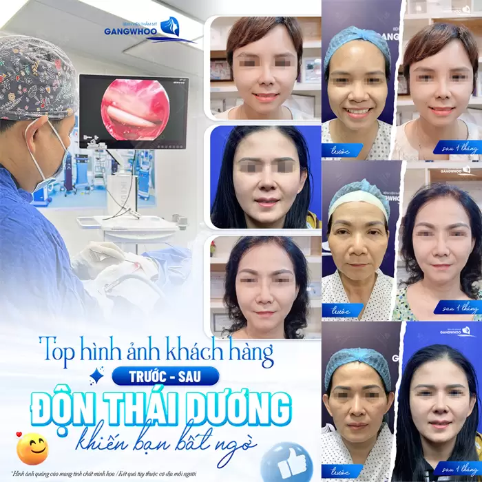 Độn thái dương cân chỉnh gương mặt thêm phần tươi trẻ và cân đối