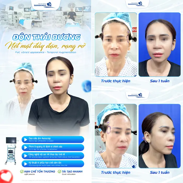 Hạ gò má cho khuôn mặt đẹp chuẩn tỷ lệ vàng, đẹp hài hòa và tràn đầy sức sống