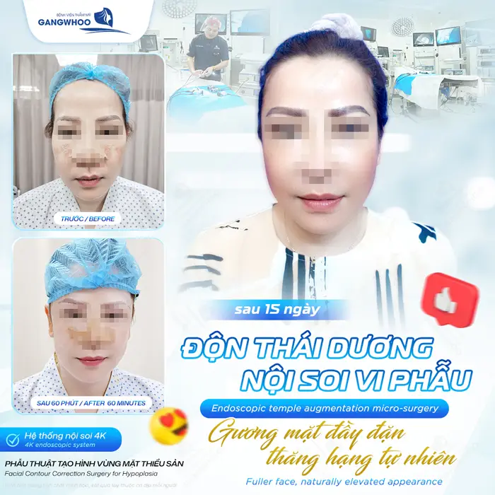 Phẫu thuật tạo hình vùng mặt thiểu sản mặt đẹp đầy đặn, thăng hạng và tôn nét hài hòa tự nhiên