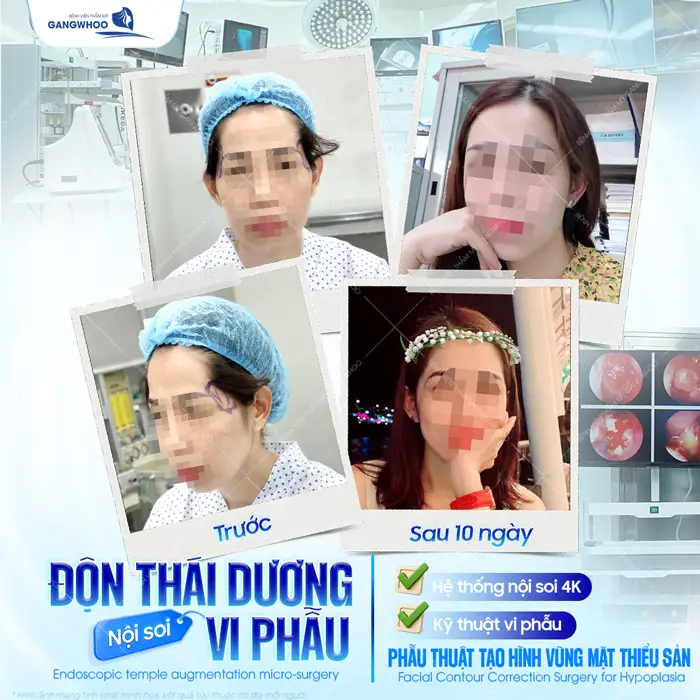 Phẫu thuật tạo hình vùng mặt thiểu sản độn vùng thái dương cho gương mặt đầy đặn, hài hòa