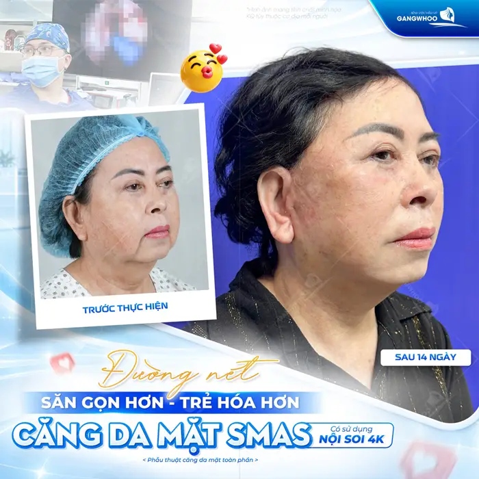 Đường nét săn gọn hơn, diện mạo trẻ hóa hơn sau thực hiện căng da mặt Smas có sử dụng nội soi