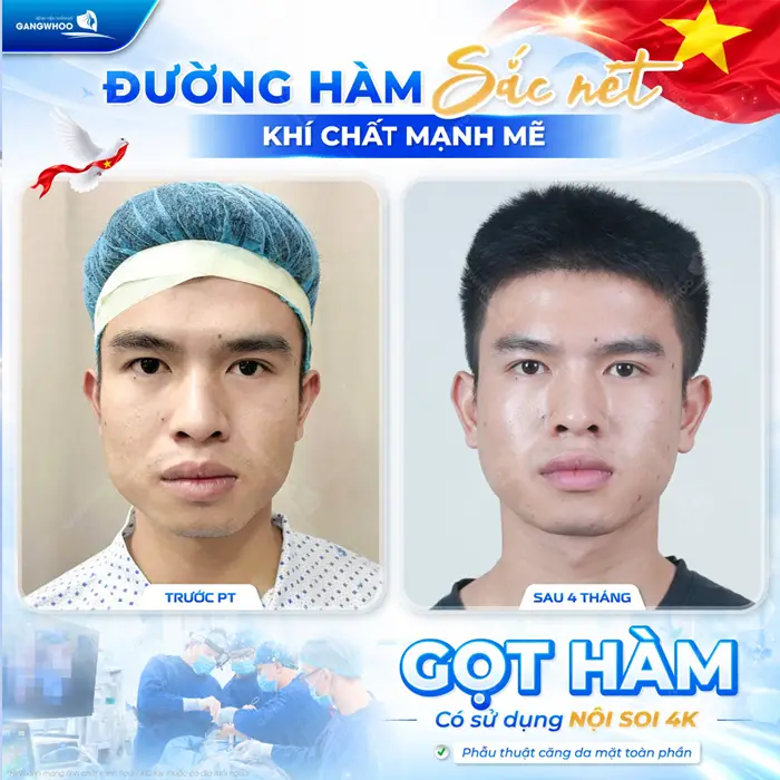 Đường hàm sắc nét khí chất mạnh mẽ sau gọt hàm có sử dụng nội soi 4K
