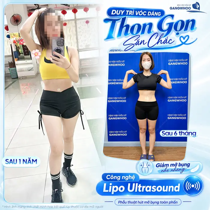 Top 11 Bệnh Viện Hút Mỡ Uy Tín Chất Lượng Tại TPHCM 8 Duy trì vóc dáng thon gọn và thêm săn chắc kết quả sau giảm mỡ bụng công nghệ Lipo Ultrasound