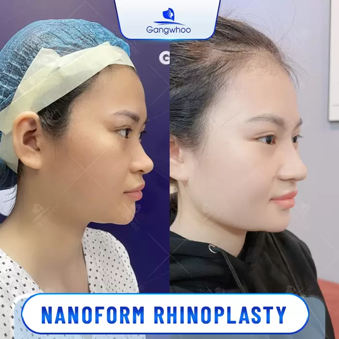 Nanoform Rhinoplasty - Becoming The Center Of Attention 5 en nang mui nanoform 5