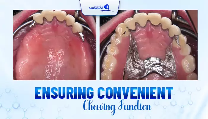 All About Removable Denture Restoration 2 en phuc hoi rang gia 1