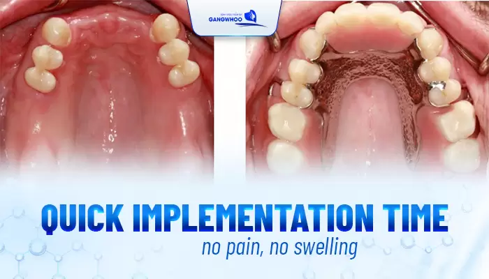 All About Removable Denture Restoration 3 en phuc hoi rang gia 4