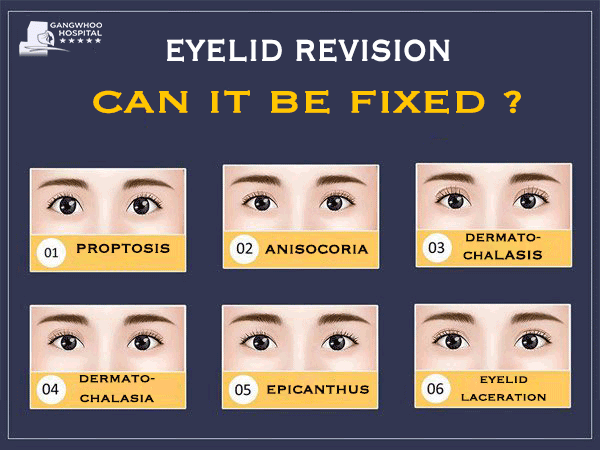 eyelid revision